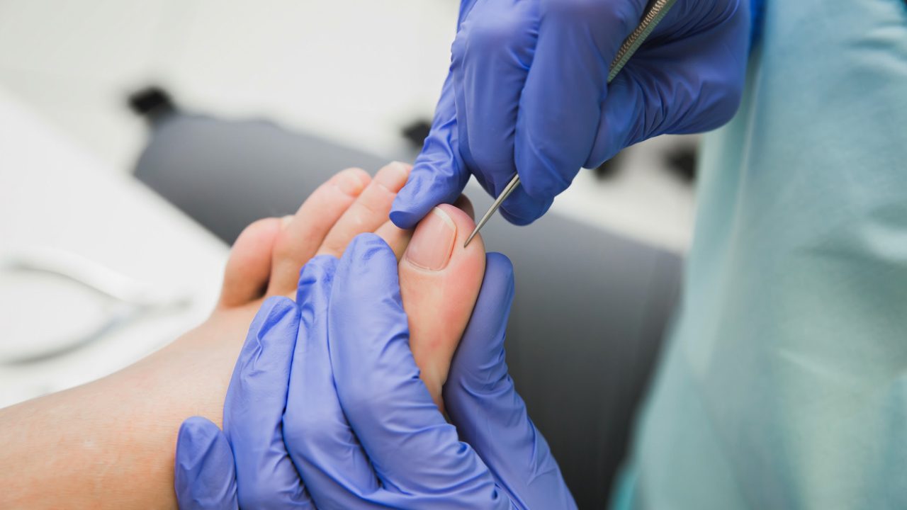 Podiatrist examining a patient's toe for an ingrown toenail
